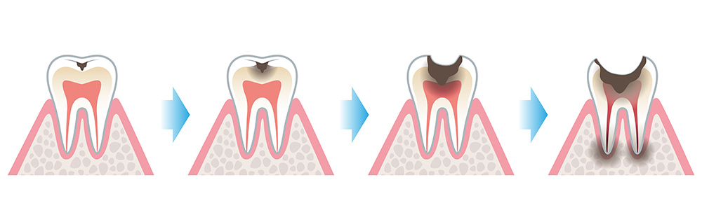 虫歯の進行する過程