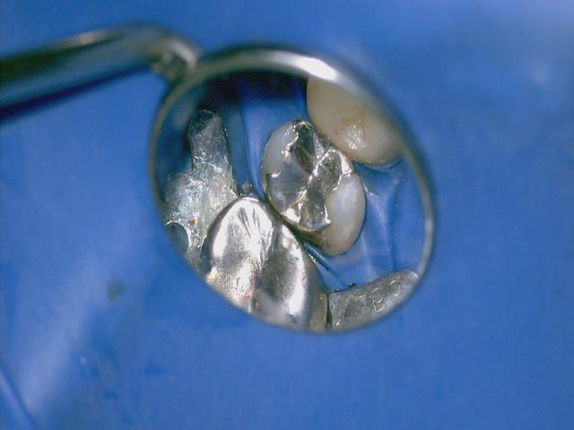 メインテナンス中に金属の下にむし歯があるのがみつかり、治療を開始した。