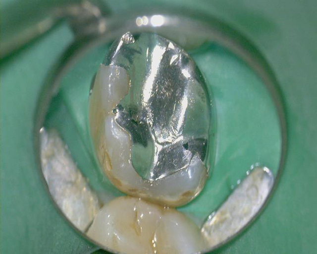 金属の下にむし歯があり、残された歯質が薄いので、歯の頭の部分のみをセラミックにて修復した。