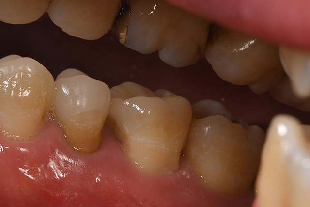 残っている歯との境目が分からないくらいの適合性と色が合った。