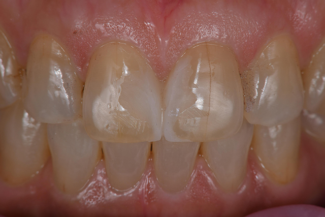 まずは歯を一切削ることなく、仮歯を入れ、患者様に歯の形をみてもらう。