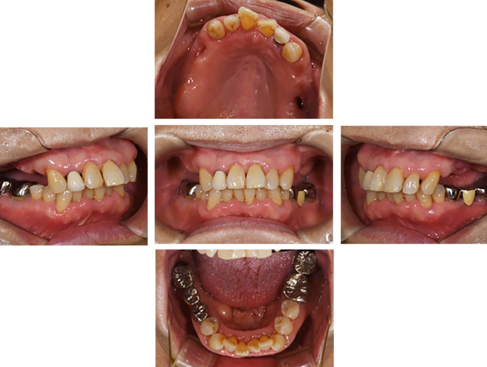 １か月間の全顎的集中治療後の歯