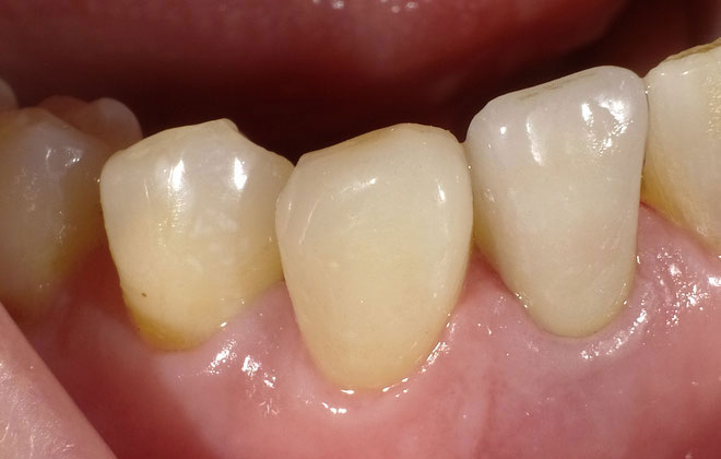 セラミック治療は、「歯を削る量を最小限に抑えられる」「虫歯を予防できる」