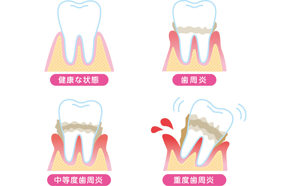歯周病で歯を失うメカニズム