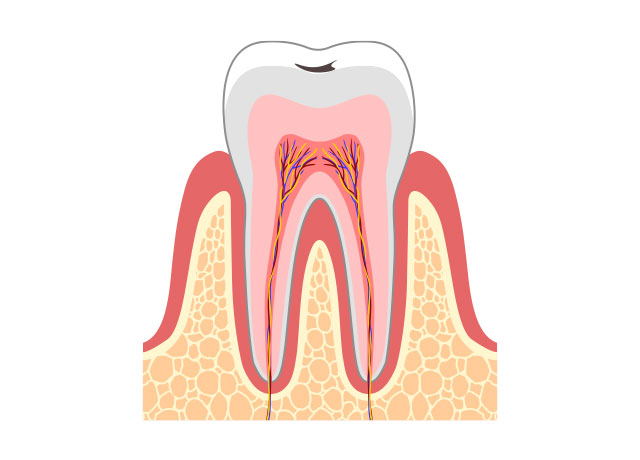 虫歯の症状 C0