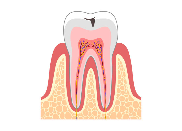 虫歯の症状 C1