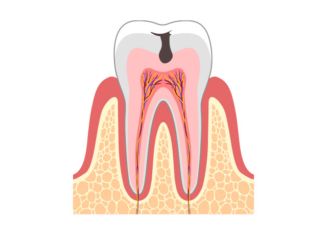 虫歯の症状 C2