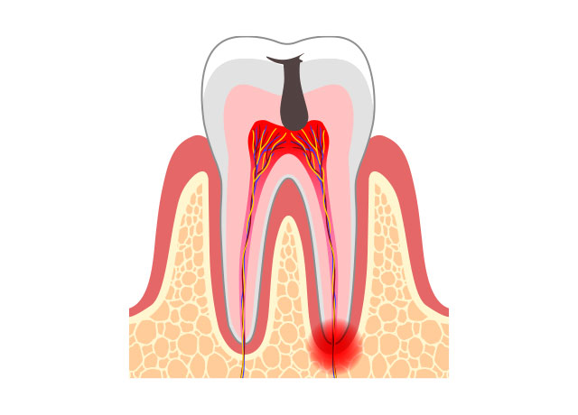 虫歯の症状 C3