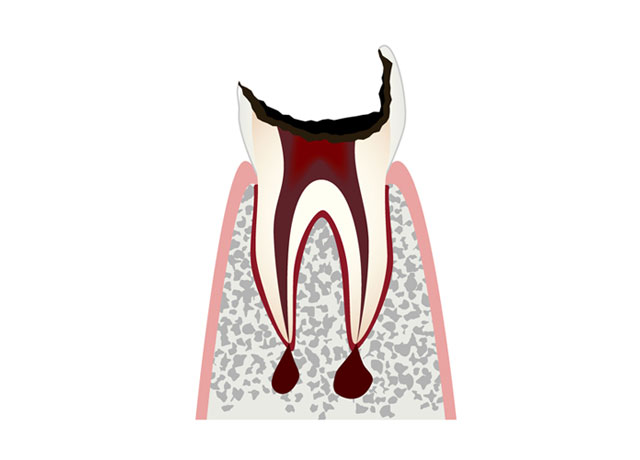 虫歯の症状 C4