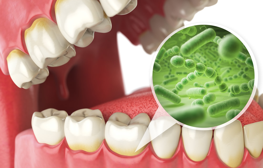歯周病の原因は、主に口の中に生息する細菌のはたらき