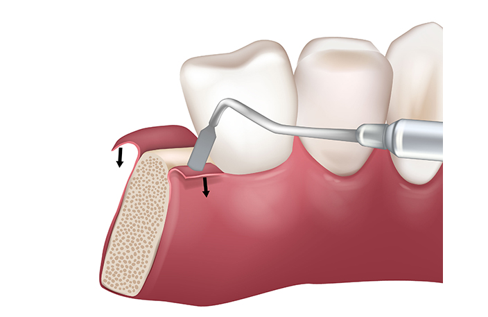 歯茎の切開と骨へのアクセス