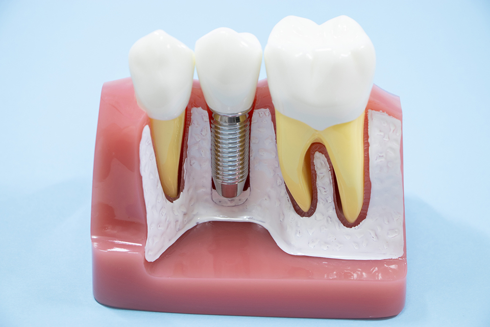 インプラント治療の骨造成術サイナスリフト｜松戸新田駅1分の歯医者