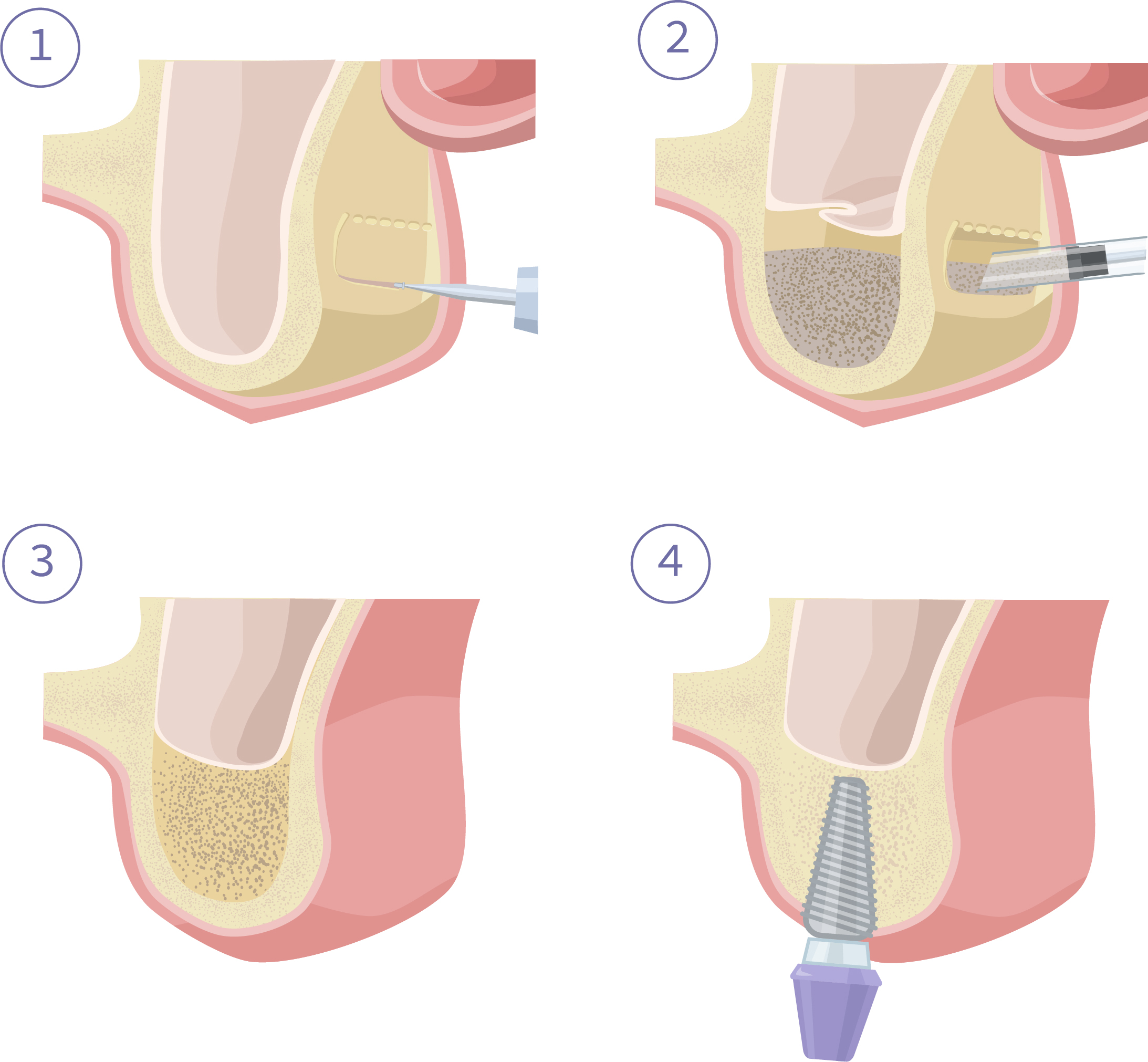 サイナスリフト