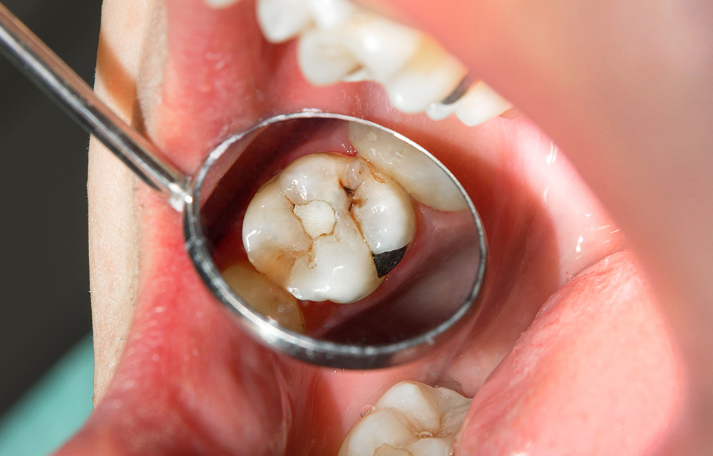 人工歯と歯質との間